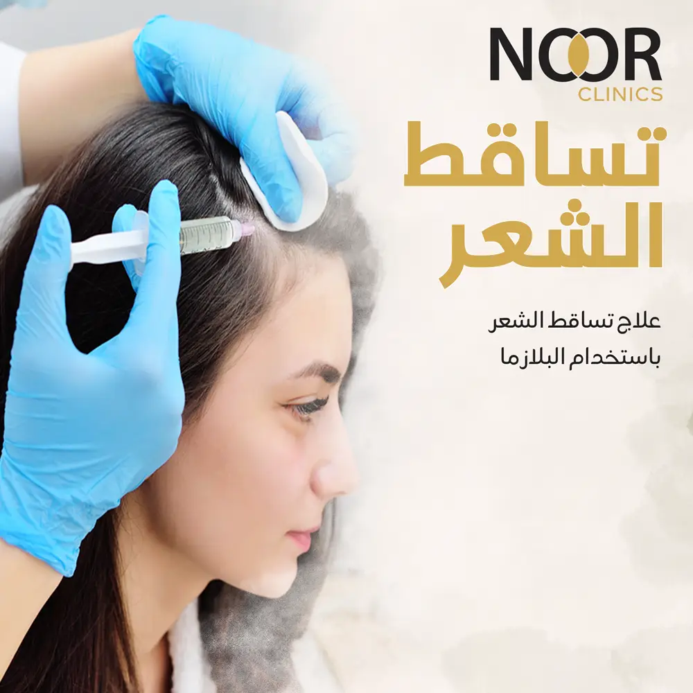 علاج تساقط الشعر باستخدام البلازما (PRP)