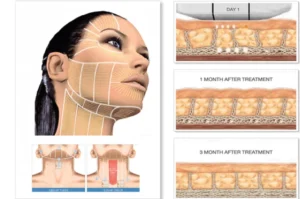 شد الوجه والرقبة بطريقة طبيعية مع تقنية الثيرا (Ultherapy)